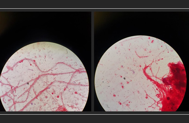 A photograph of two slide specimens. They are circular against a black background. Inside the slides, there are bright white backgrounds with red splatters and lines on top.