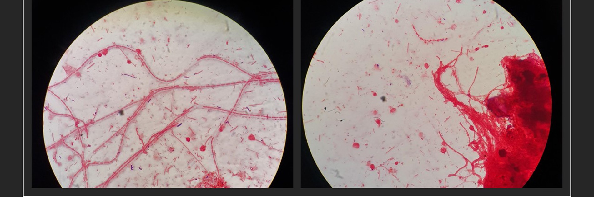 A photograph of two slide specimens. They are circular against a black background. Inside the slides, there are bright white backgrounds with red splatters and lines on top.